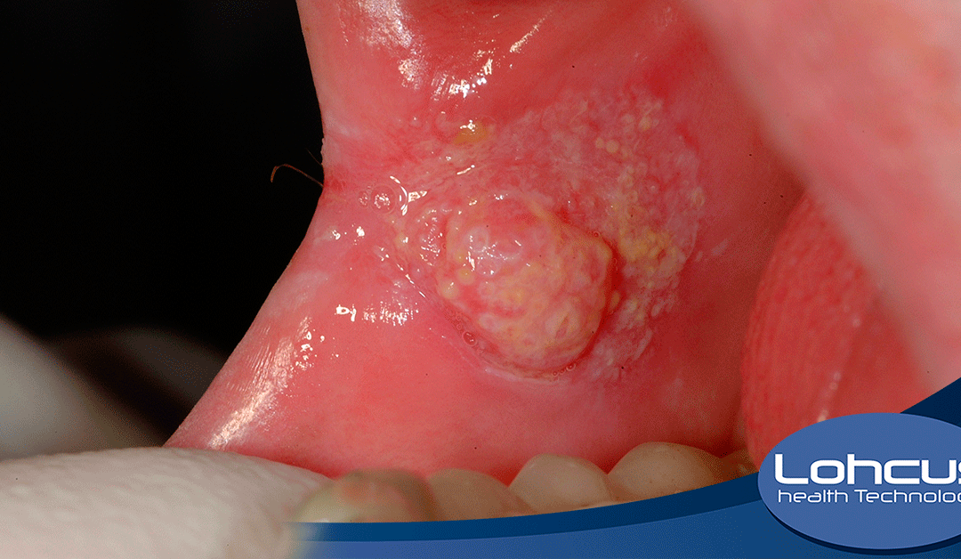 Combata o Cancro Oral neste Novembro