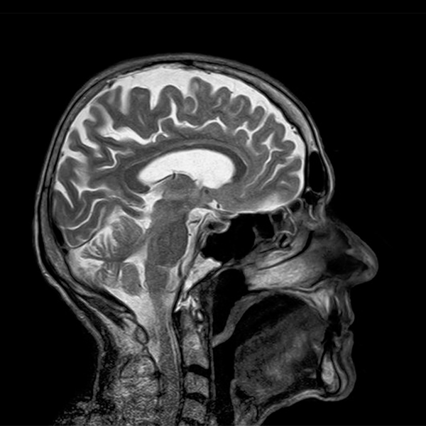 Ligação entre doenças gengivais e o declínio cognitivo na doença de Alzheimer
