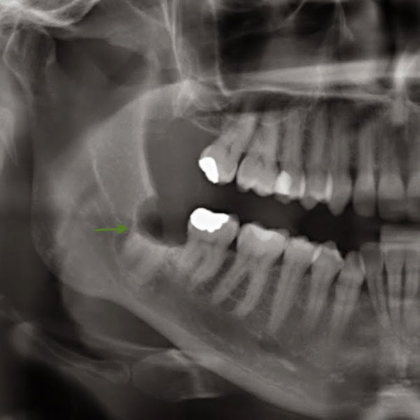 Analisando raízes mandibulares do dente do siso após a Coronectomia