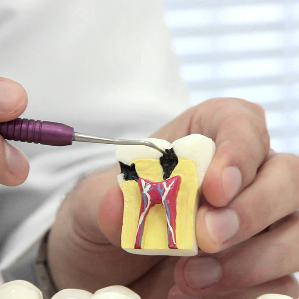Adiar a intervenção restauradora de cárie em dentina oclusal por vedação não-invasiva