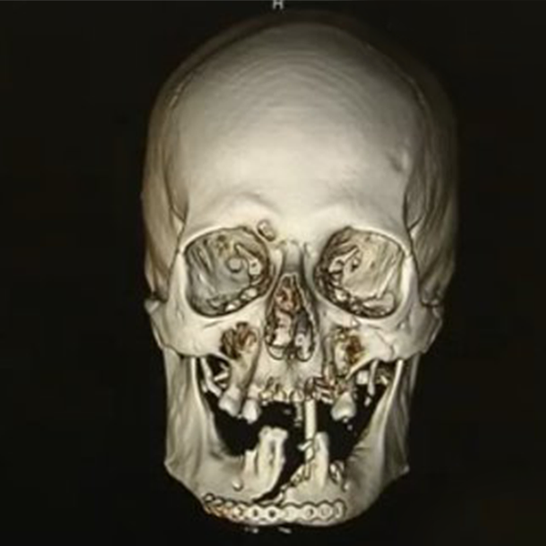 Cirurgiões Australianos repararam maxilar de homem após acidente com Motosserra
