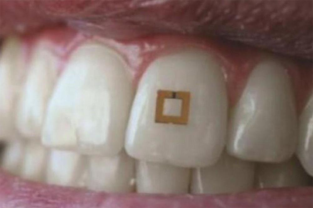 Sensor colado no dente rastreia alimentos ingeridos